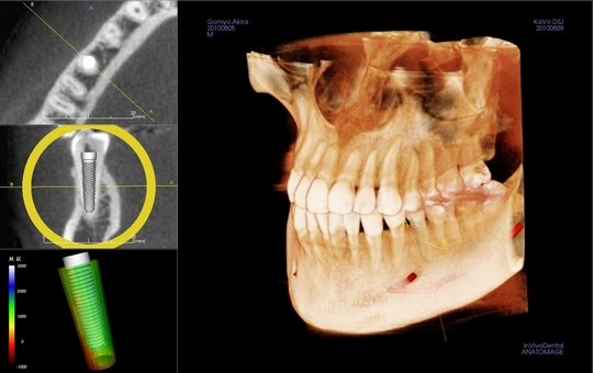 Ctを使った治療 平沢歯科 秦野市